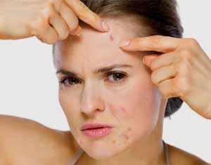 How Hormones Cause Adult Acne in Women
